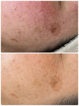 アンド ユー(and.yu)/シミケア・美肌コース1回