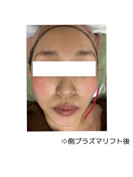 カヌヌ(Kanunu)/小顔リフト