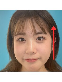 ネクスフィット(Nexfit)/小顔矯正フェイスリフトの効果