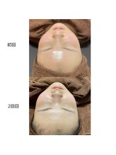 ヴィヴィエ 佐賀店(ViVier)/ララピール症例　2回