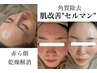（乾燥、赤みのお悩み）セルマンにて肌改善　¥22000→¥11000