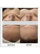 ホワイトニングショップ 広島店(WHITENING SHOP)/【ハーブピーリング】