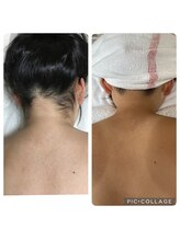 アンジュブリアン(Ange brillant)/キッズ脱毛もお任せ♪