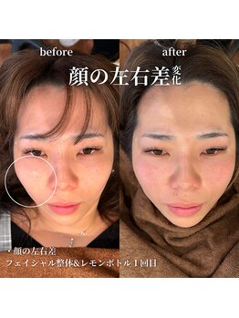 フェアリーフェイス 南森町店(Fairy Face)/南森町/小顔矯正&レモンボトル