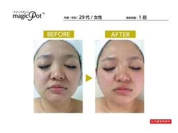 ラトナ(RATNA)/ラジオ波