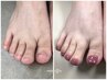 【女性/フット/道内初の深爪矯正】1回お試し特別価格/即日見た目改善¥22000→