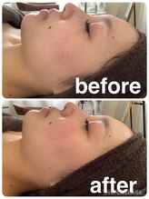 ギンザアール(GINZA R.)/小顔フェイシャル◎