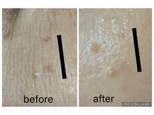 高周波でポイントシミケア♪ダウンタイムなし/直後からメイクOK