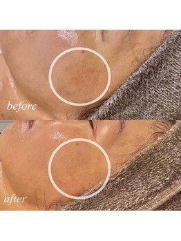 エン(en.)/シミケア.*