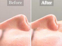 ボーンオム(Born Homme)/毛穴洗浄＋美容液導入：20代女性