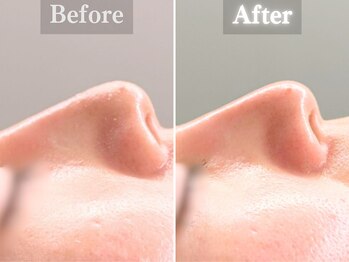 ボーンオム(Born Homme)/毛穴洗浄+美容液導入:20代女性