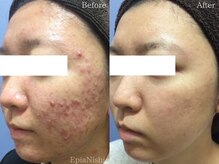 エピア 西尾店(Epia)/全顔ニキビ/20代女性