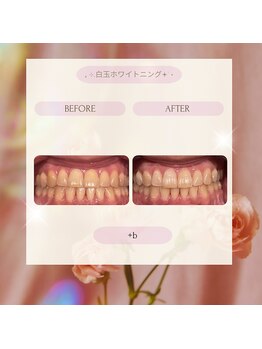 プラスビーセルフ(+b self)/ホワイトニングビフォーアフター