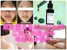 フワリの雰囲気（肌質改善ピーリング11800円ニキビケア/シミケア/しわケア/美白）