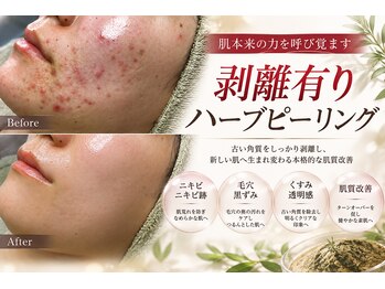 ダブル(W)の写真/何をしても満足できなかった肌へ。剥離有りハーブピーリングで本格肌ケア★