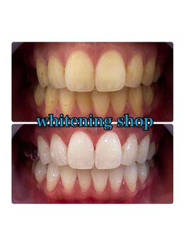 ホワイトニングショップ 所沢店/before&after美白ホワイトニング