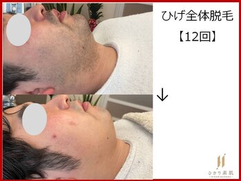 ひかり素肌/ひげ脱毛12回