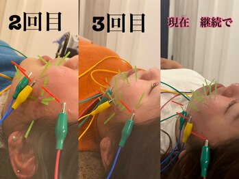 ソラナ(Solana)/肌荒れ・ニキビ改善