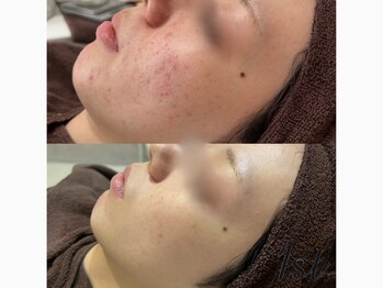 ファースト(1st)/