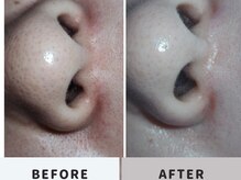 ニコリー(nicoly)/毛穴吸引◎before→after