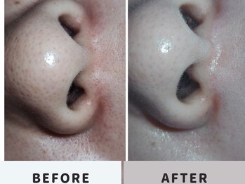 ニコリー(nicoly)/毛穴吸引◎before→after