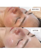 ミーティス/Gloss肌ピーリングで美肌ケア♪