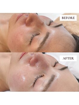 ミーティス/Gloss肌ピーリングで美肌ケア♪