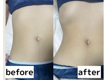 小顔専門店Lift(リフト)川崎/小顔専門店Lift|Before After