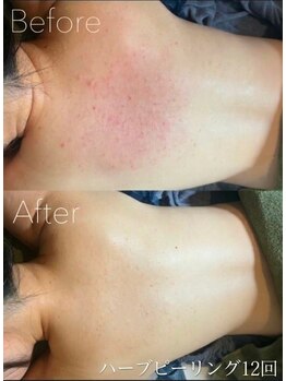 ベル 草津(Belle)/ハーブピーリング｜背中キレイ肌