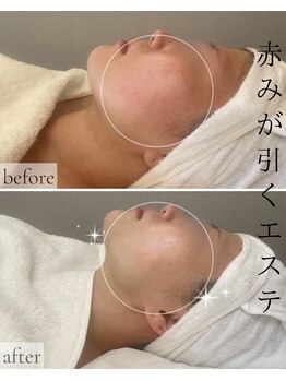 pureの写真/シリーズ人気No.1☆【水光肌】乳酸菌ピーリング15,000円→9,900円｜90分でハリツヤUP・くすみ改善