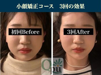 キュープ 表参道店(Qpu)/続けた方しか感じられない変化♪