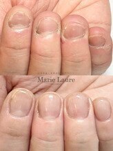 マリーロール 梅田店(Marie Laure)/自爪育成/深爪矯正/ネイルケア