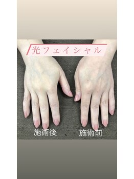 アクア(Aqua)/光ハンド