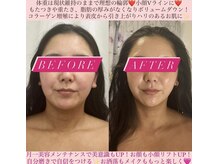 フェミニー(Feminy)/小顔整顔リフト