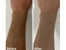 グレイス(Grace)/メンズひじ下脱毛