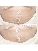 オーキッド(ORCHID)/美肌力UP光フェイシャル！