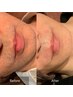 男性必見！３回髭脱毛無料クーポン♪【頬・鼻下・顎・首】