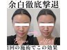 【ブライダル徹底ケア】最速で圧倒的小顔★お顔のお悩み丸ごと解消30分￥5900