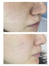 モエ ビューティーサロン(moe Beauty Salon)/1ヶ月肌質改善プログラム