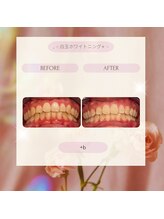 プラスビーセルフ(+b self)/ホワイトニングビフォーアフター