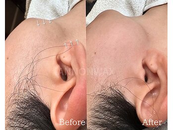 ポアラ(POARA)/毛穴/ワックス脱毛