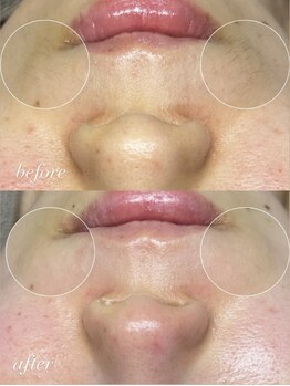 サロンドシェフィア(Salon de Chefia)/30代前半女性 症例写真