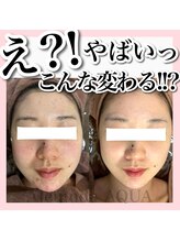 アルムダアクア 天王寺店(Aleumda AQUA)/大阪/天王寺/ハーブピーリング
