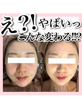 アルムダアクア 天王寺店(Aleumda AQUA)/大阪/天王寺/ハーブピーリング