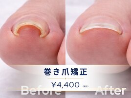 【痛みを我慢しない】巻き爪矯正