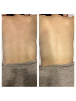 モンド 駒込店(monde)/背中ハーブピーリング