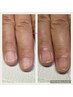 【メンズ】深爪矯正卒業の方、小さい爪、貝爪など縦長に爪を育成したい方