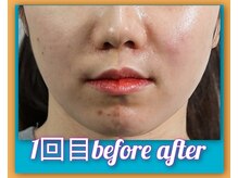 美容大国、韓国の超最新肌管理の技術1度で実感♪水光肌別次元肌