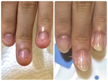 トラストネイル 佐野店(TRUST Nail)/深爪育成/矯正
