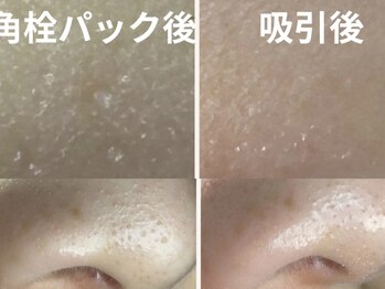 コハク(kohaku)/鼻すっきり毛穴コース b/a